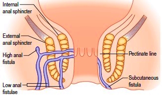 anal fistulae picture Hypoactive sexual desire disorder hsdd
